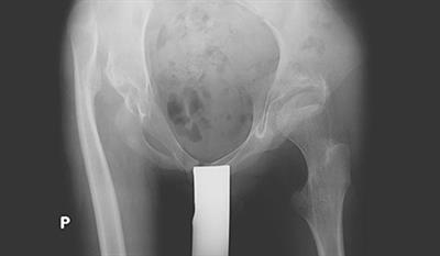 Parents and Caregivers Satisfaction After Palliative Treatment of Spastic Hip Dislocation in Cerebral Palsy